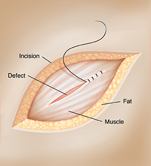 Incision in skin showing hernia being sutured closed.