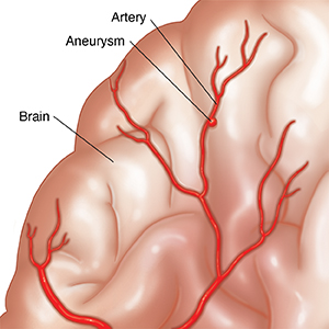 Closeup of brain showing mycotic aneurysm on artery.