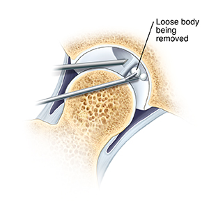 Cross section of hip joint showing arthroscopic instruments removing loose piece of tissue from joint. Closeup of arthroscope tip in hip joint and instrument removing loose body.