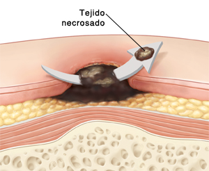 Corte transversal de la piel en donde se ve una úlcera por decúbito con cicatrización en el centro. Una flecha atraviesa el tejido cicatricial y muestra que se está quitando parte del tejido.