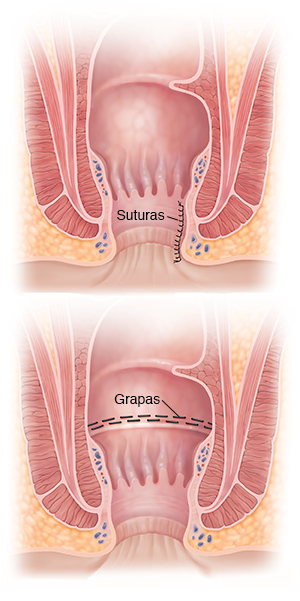 Corte transversal de ano que muestra suturas. Corte transversal de ano que muestra grapas.