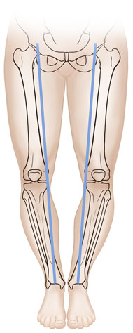 Vista frontal de las piernas de un niño donde se observan los huesos con las piernas en arco.