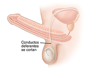 Vista lateral del sistema reproductor masculino donde puede verse el recorrido que hace el esperma después de una vasectomía.